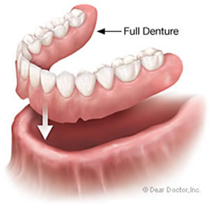 Dentures 